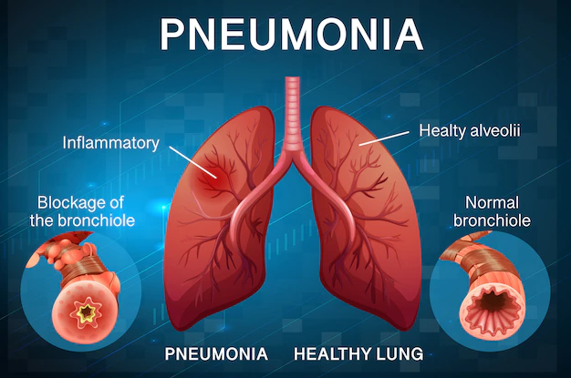 peumonia